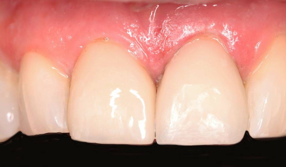 Hollon Dental Patient After Veneers Procedure