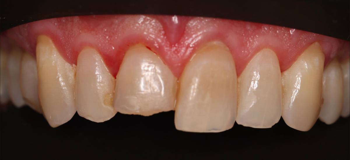 Hollon Dental Patient Before Same Day Crowns Procedure