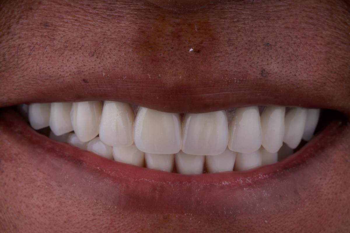 Hollon Dental Patient After Dental Implants