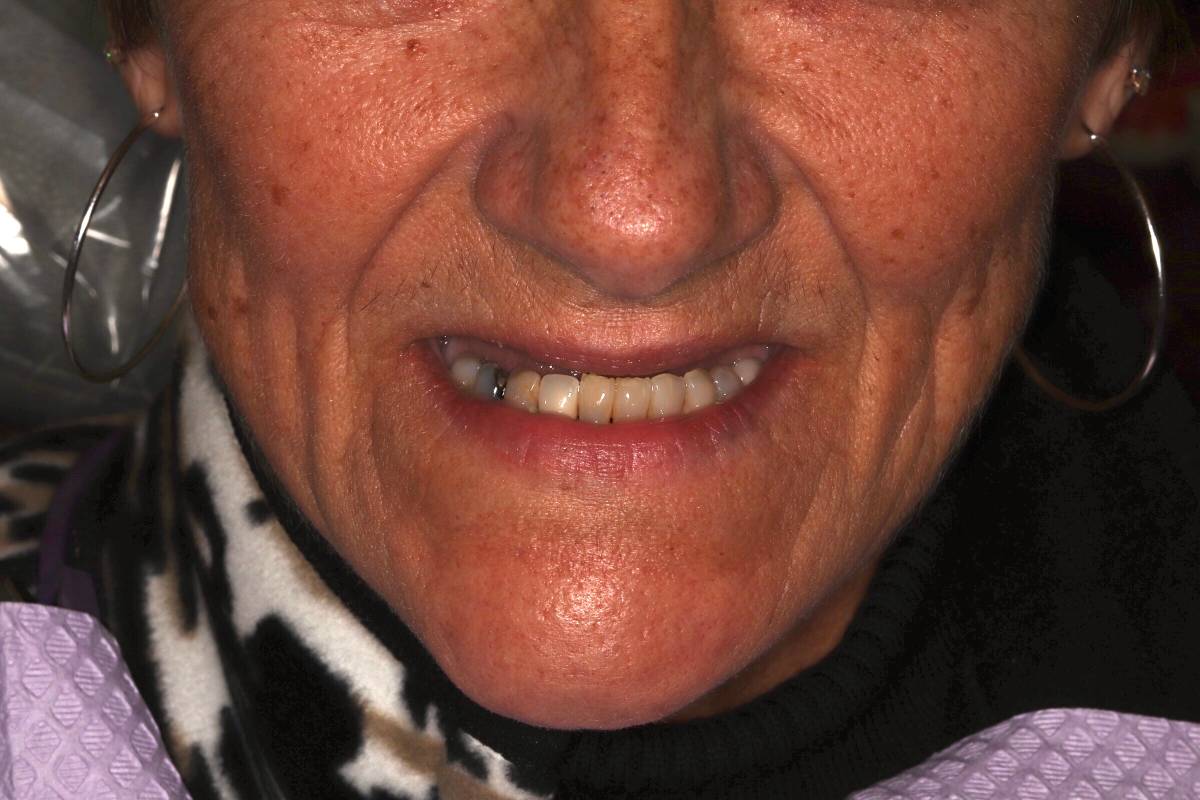 Hollon Dental Patient Before Dental Implants