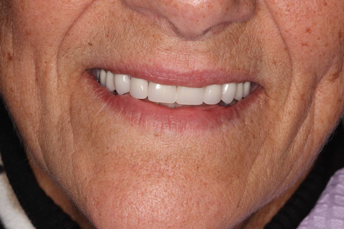 Hollon Dental Patient After Dental Implants