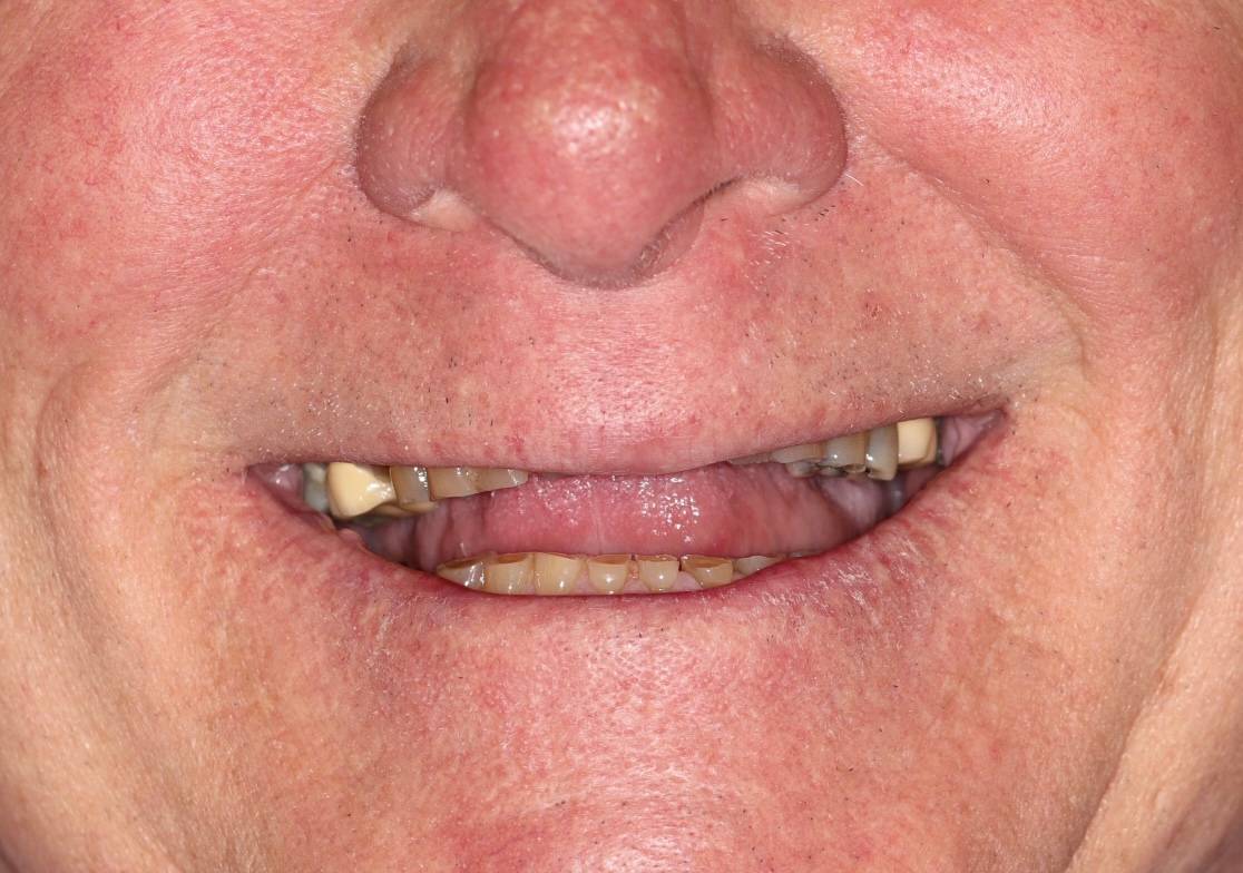 Hollon Dental Patient Before Full Mouth Reconstruction