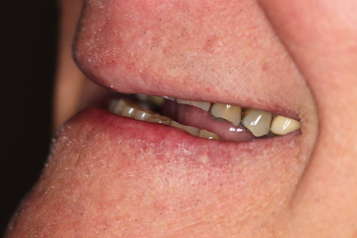 Hollon Dental Patient Before Full Mouth Reconstruction
