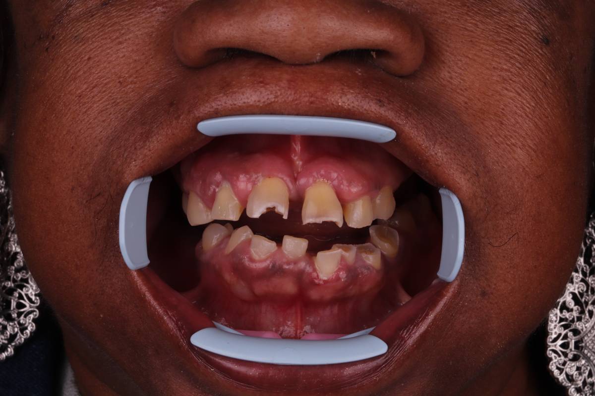 Hollon Dental Patient Before Dental Implants