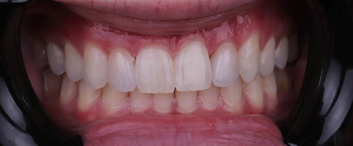 Hollon Dental Patient Before Veneers Procedure