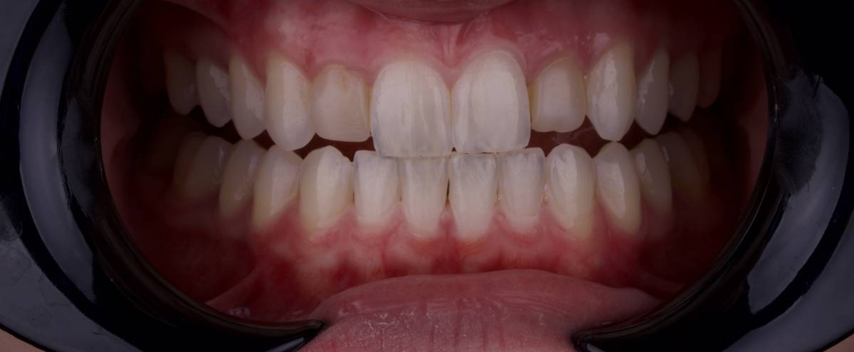 Hollon Dental Patient Before Veneers Procedure