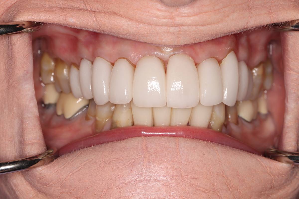 Hollon Dental Patient After Smile Makeover Crowns Procedure
