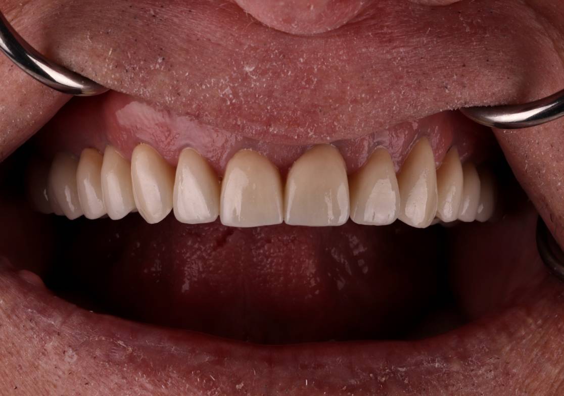 Hollon Dental Patient After Full Mouth Reconstruction