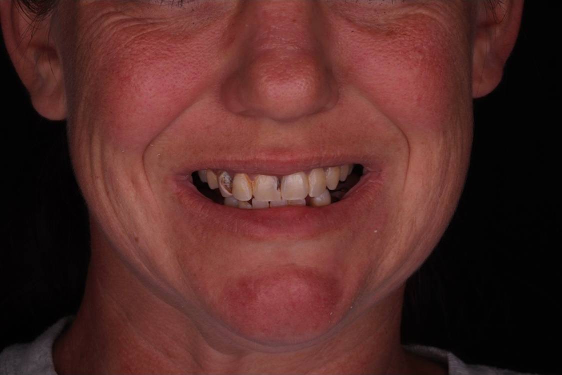 Hollon Dental Patient Before Smile Makeover Crowns Procedure