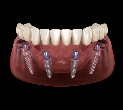 all-on-4-dental-implants