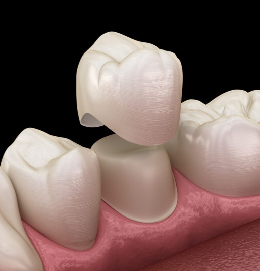 cerec-same-day-crowns-restore-your-smile