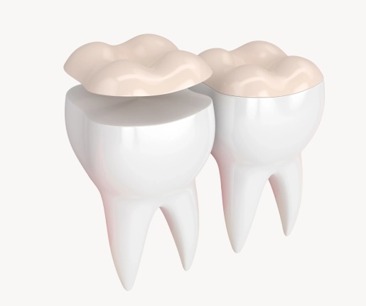 Damaged Teeth With Inlays & Onlays