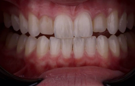 Img-porcelain-veneers- Before 1