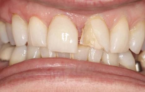 Img-porcelain-veneers- Before 3