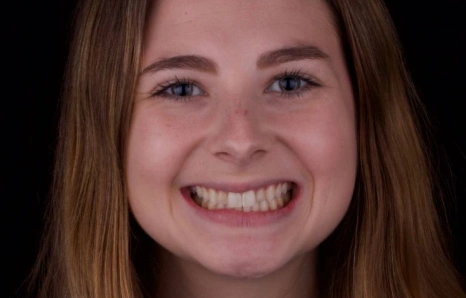 Img-porcelain-veneers- Before 4