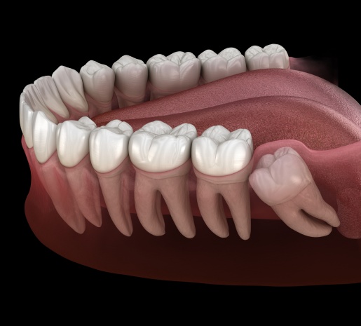 Safe and Comfortable Wisdom Teeth Removal